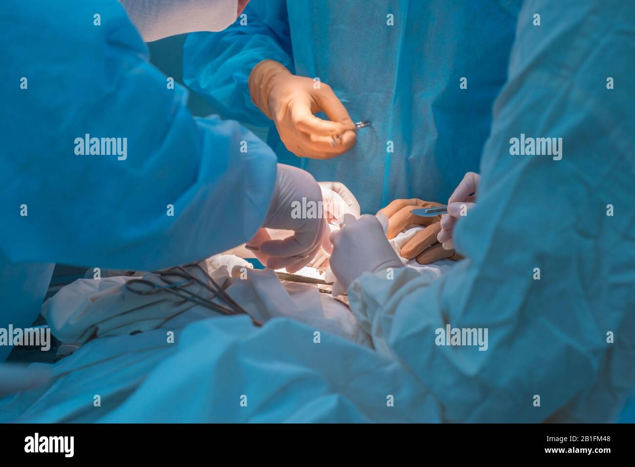Nahaufnahme, die Hände von Kinderchirurgen und ein Assistent, der einen kleinen Patienten mit einer Hinter-Ohr-Lymphadenitis operiert. In einem sterilen Operationssaal. R Stockfoto