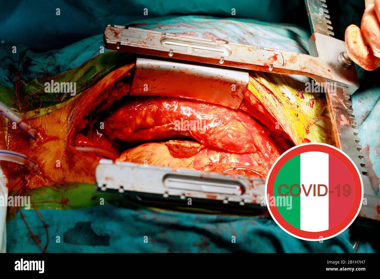 Bereit für einen chirurgischen Coronavirus COVID-2019-Test chinesische Infektion ist das Middle East Respiratory Syndrome Coronavirus Stockfoto