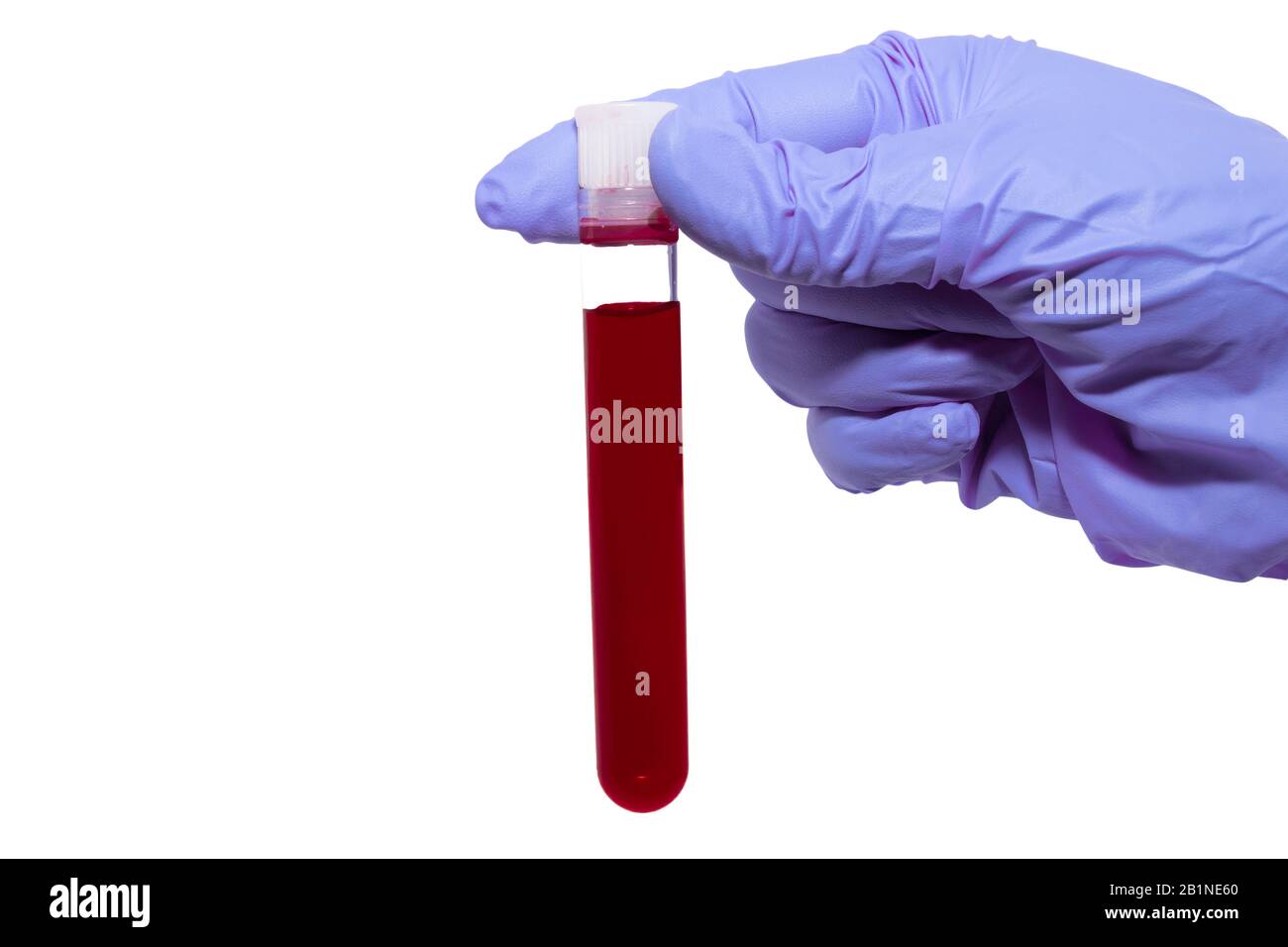 Hand eines Labortechnikers mit einem Röhrchen Blutprobe Stockfoto