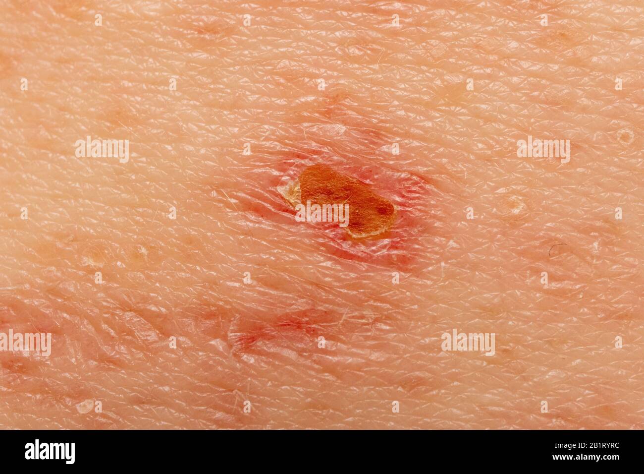 Schindeln Herpes Zoster-Infektion Ausschlag Kaukasion männlich 59 Jahre alt Stockfoto