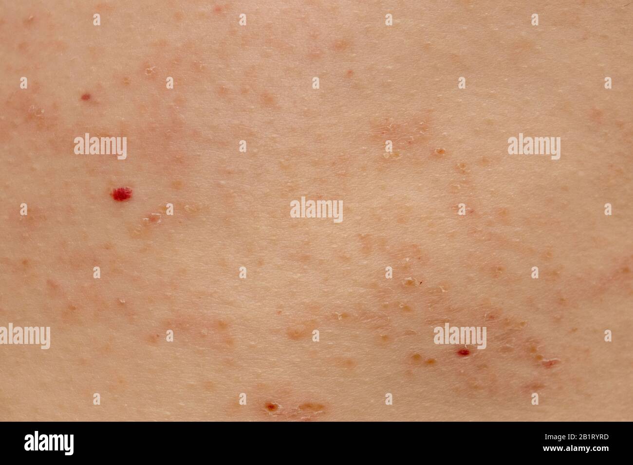 Schindeln Herpes Zoster-Infektion Ausschlag Kaukasion männlich 59 Jahre alt Stockfoto