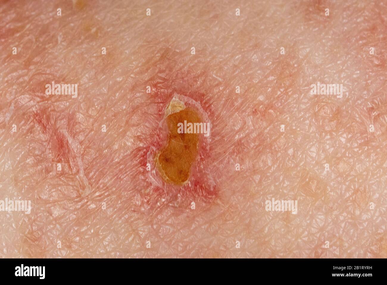 Schindeln Herpes Zoster-Infektion Ausschlag Kaukasion männlich 59 Jahre alt Stockfoto