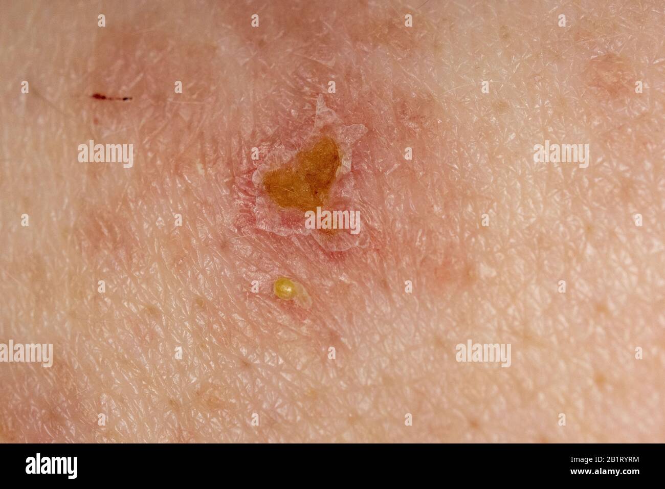 Schindeln Herpes Zoster-Infektion Ausschlag Kaukasion männlich 59 Jahre alt Stockfoto