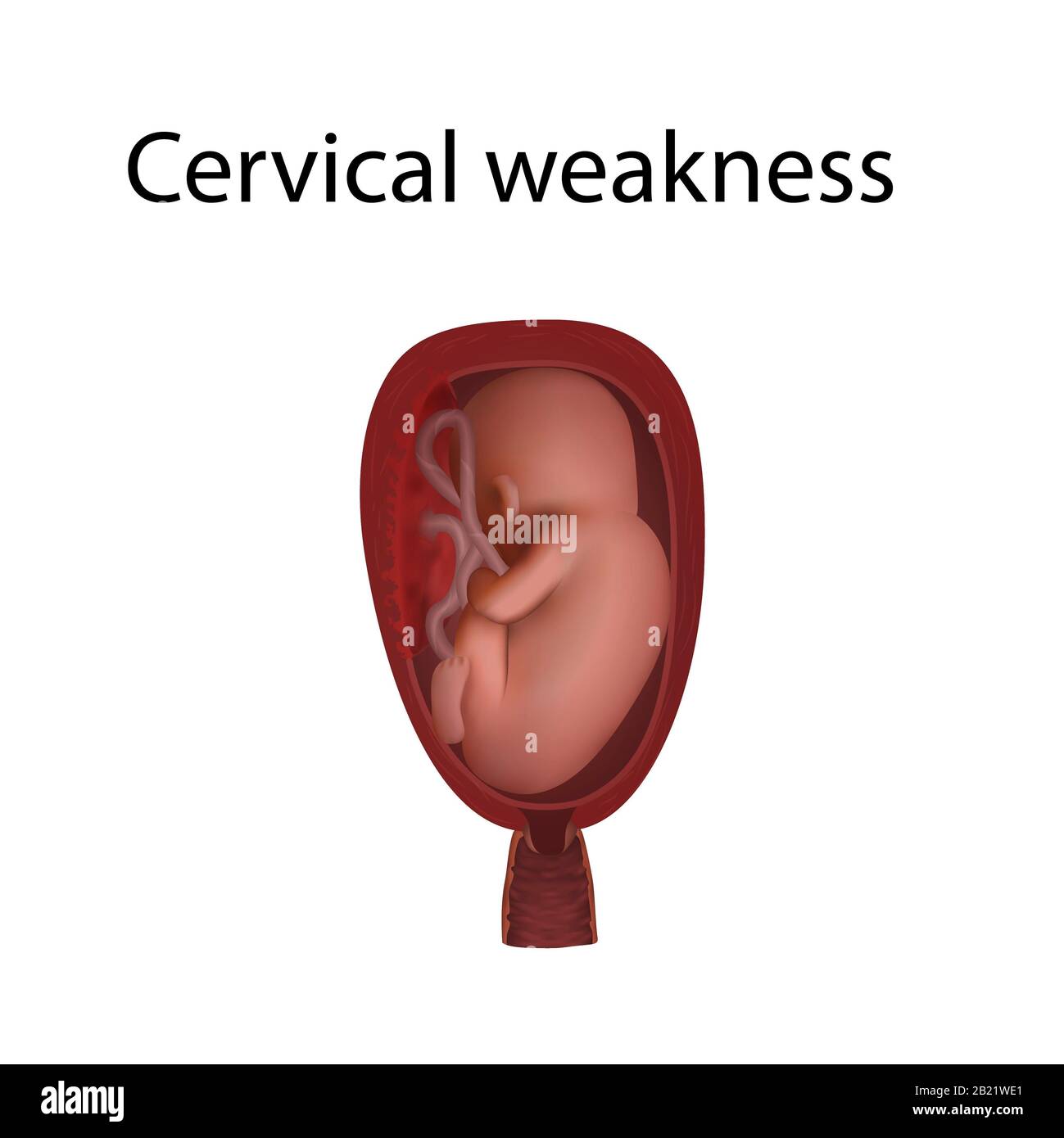 Zervikale Schwäche, Abbildung Stockfoto