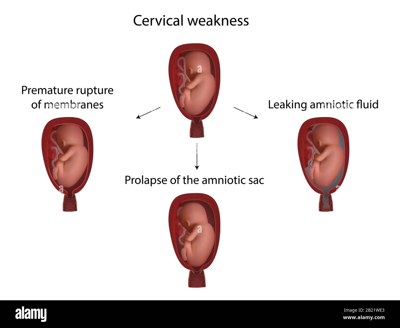 Komplikationen bei Halsschwäche, Abbildung Stockfoto