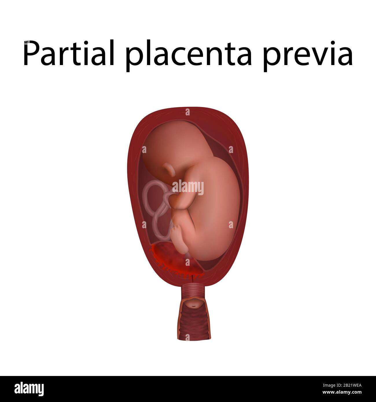 Partielle Plazenta-Prävia, Abbildung Stockfoto