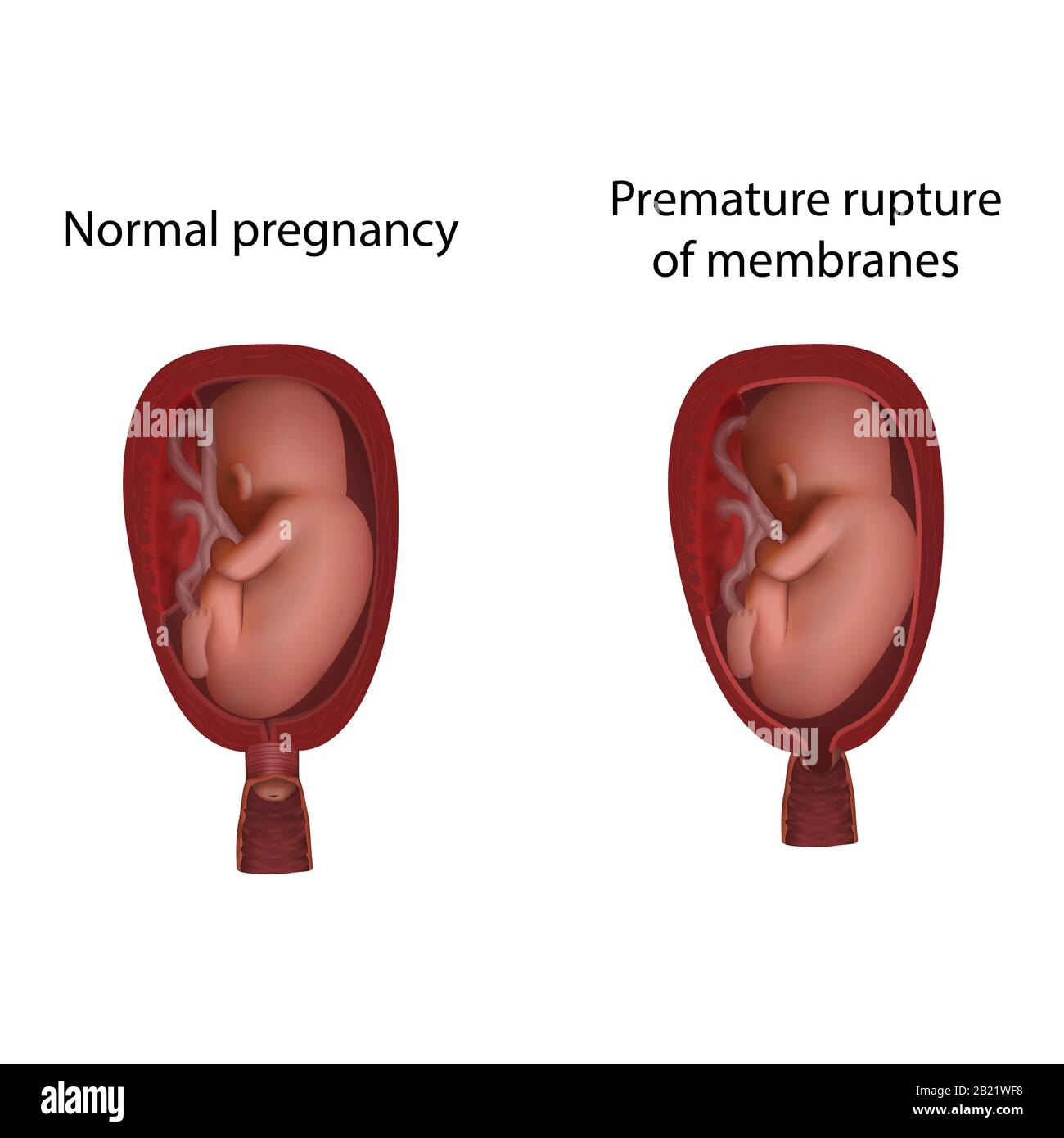 Vorzeitiger Bruch der Membranen und normal, Abbildung Stockfoto