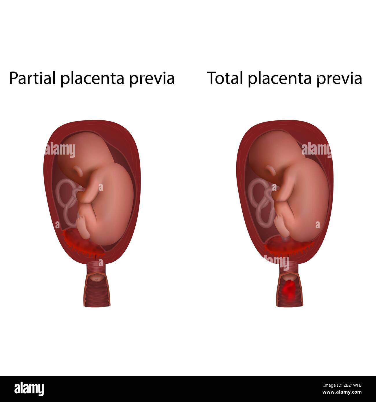 Partielle und totale Plazenta-Prävia, Abbildung Stockfoto