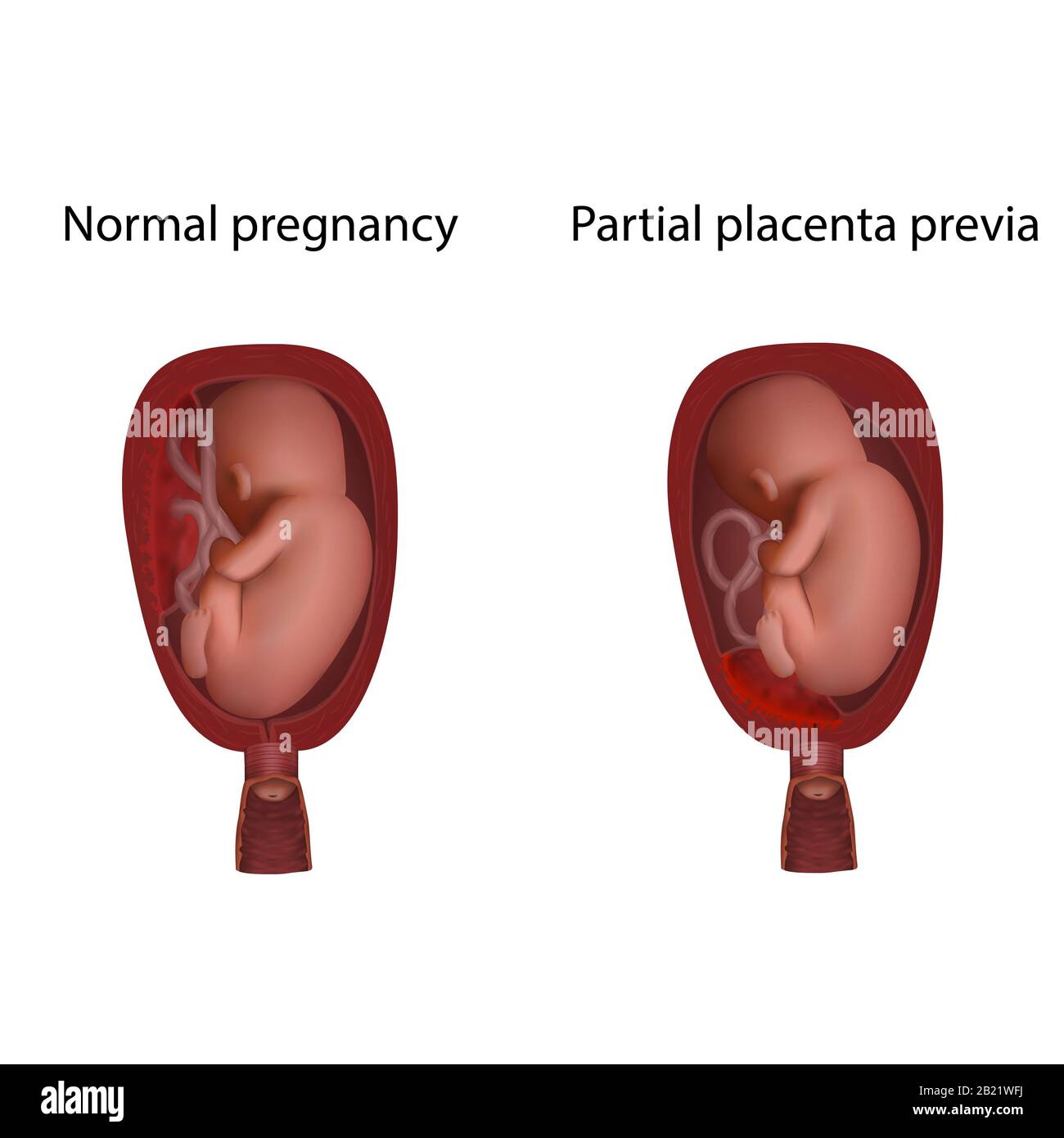 Partielle Plazenta prävia und normale Schwangerschaft, Abbildung Stockfoto