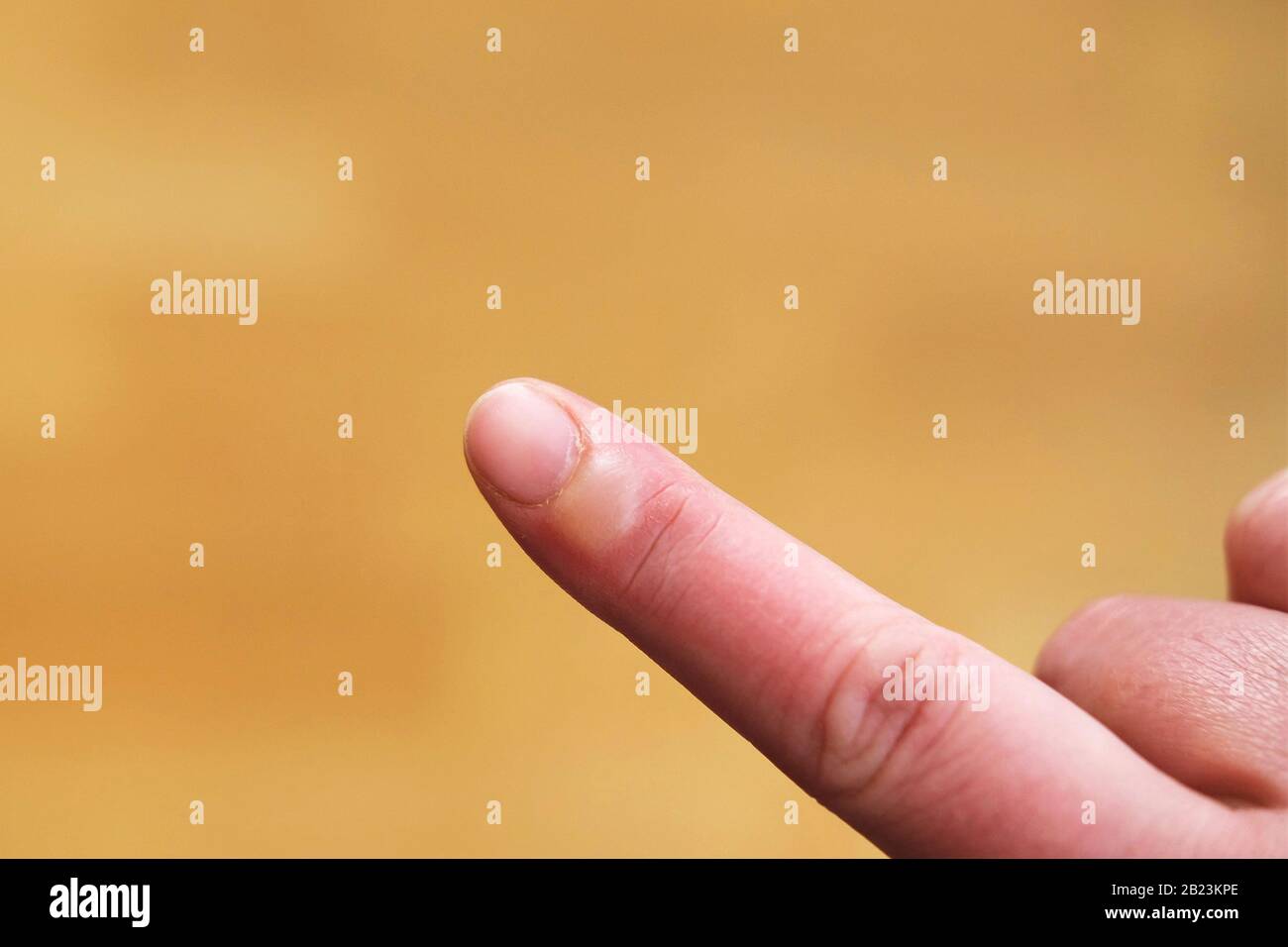 Hauttrauma Stockfotos Und Bilder Kaufen Alamy