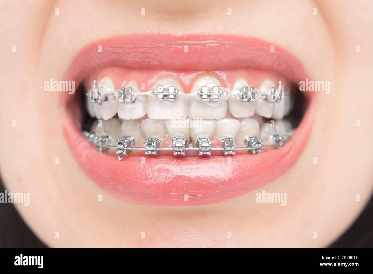Nah an Zahnspangen. Halterungen an den Zähnen nach dem Aufhellen. Selbstligierende Halterungen mit Metallbändern und grauen Gummibändern oder Gummibändern Stockfoto