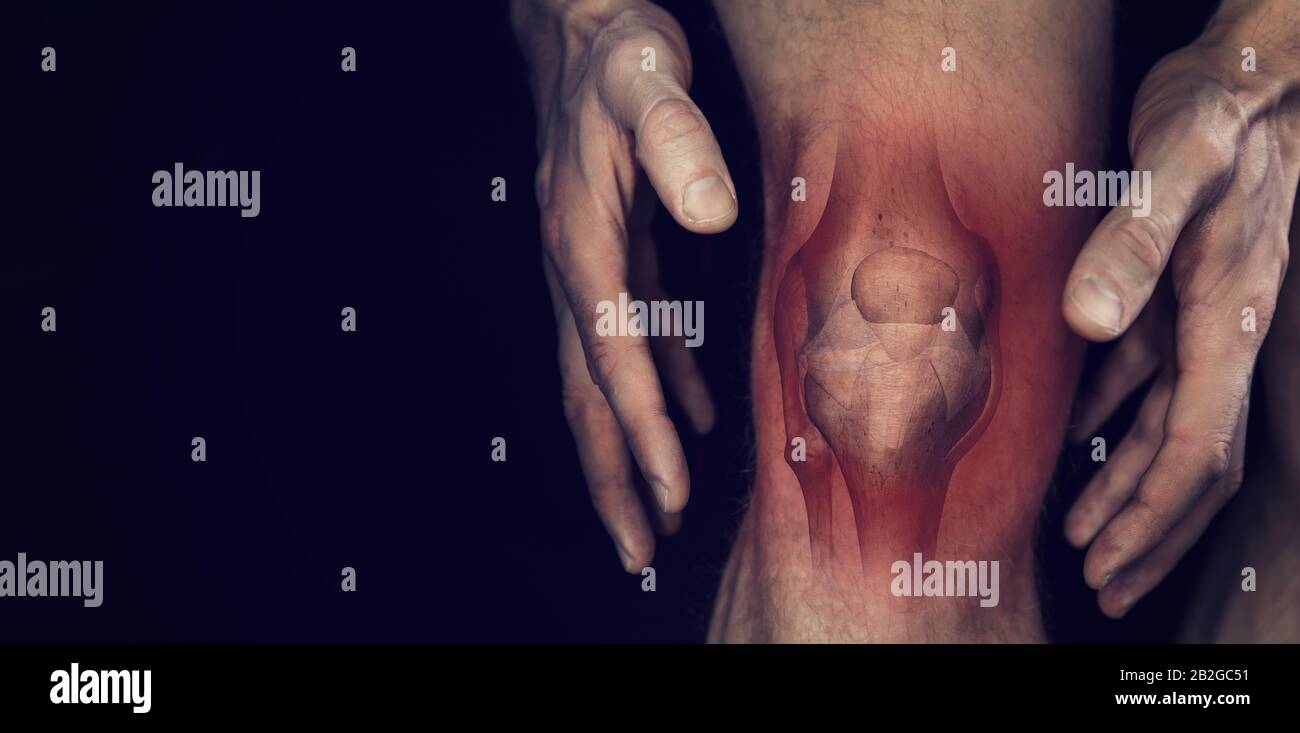 Knieschmerzen. Männliches Bein mit Entzündungszeichnung am Knochengelenk auf schwarzem Hintergrund. Platz kopieren Stockfoto