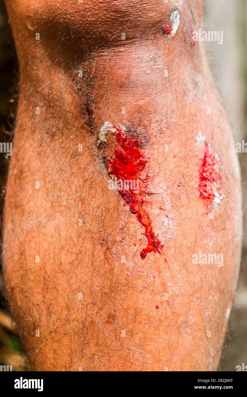 Blutendes Verletztes Bein, Infektionsgefahr Stockfoto