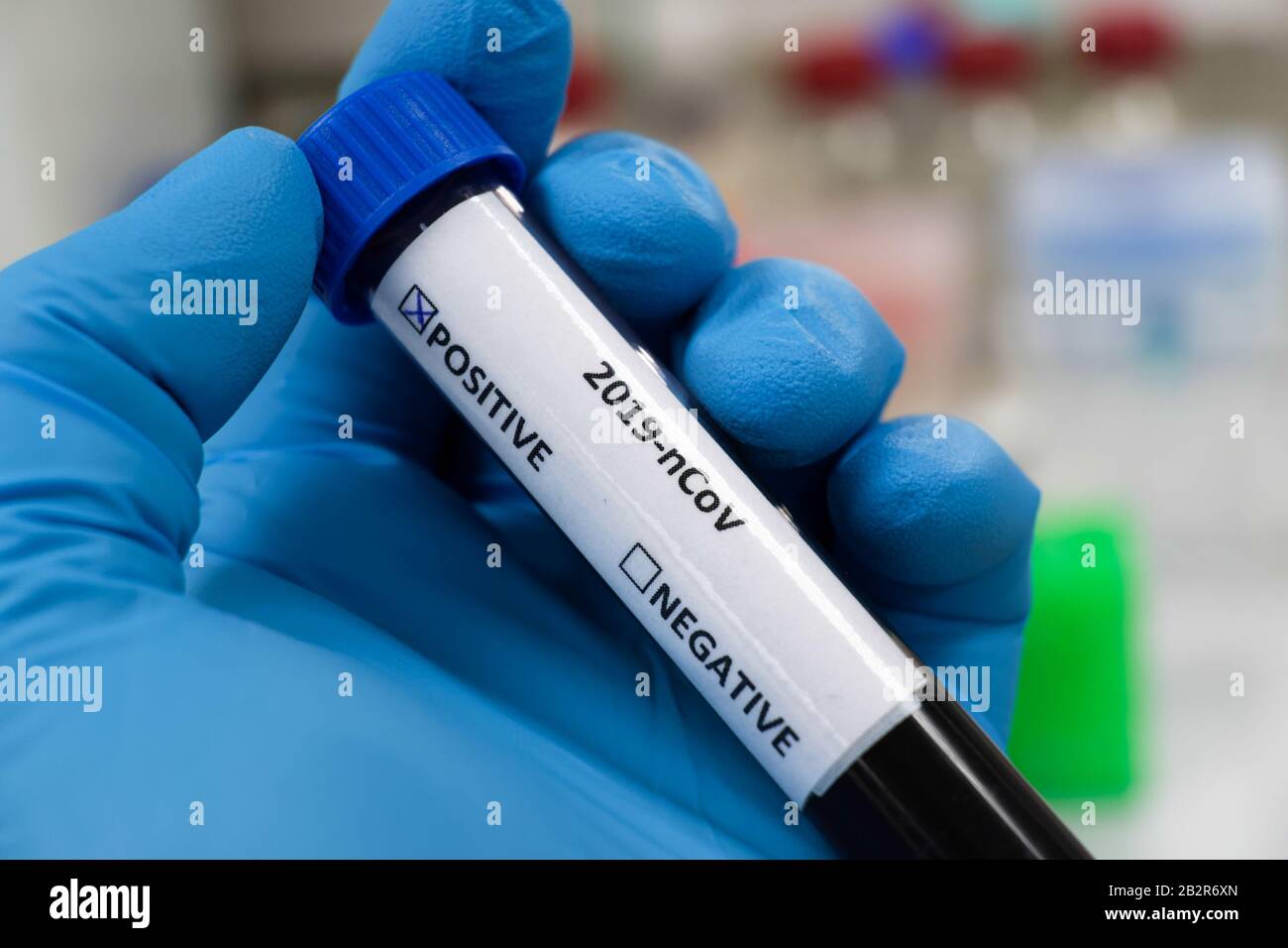 Bluttest für COVID-19. Untersuchung einer Blutprobe auf das Vorhandensein von SARS-COV-2-Coronavirus. Stockfoto
