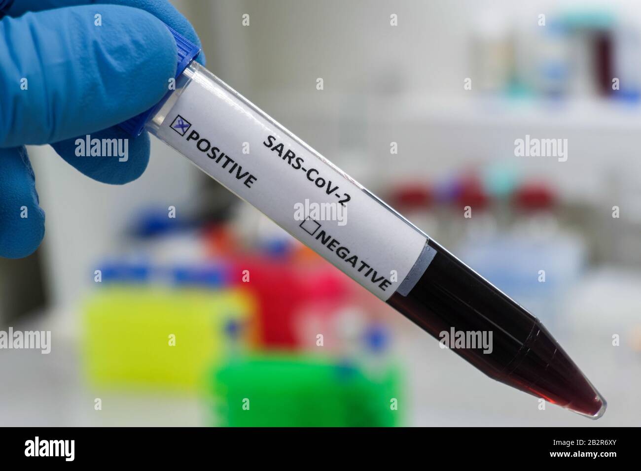 Bluttest für COVID-19. Untersuchung einer Blutprobe auf das Vorhandensein von SARS-COV-2-Coronavirus. Stockfoto