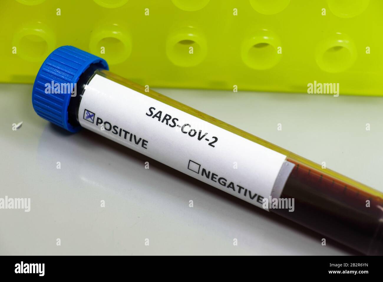 Bluttest für COVID-19. Untersuchung einer Blutprobe auf das Vorhandensein von SARS-COV-2-Coronavirus. Stockfoto