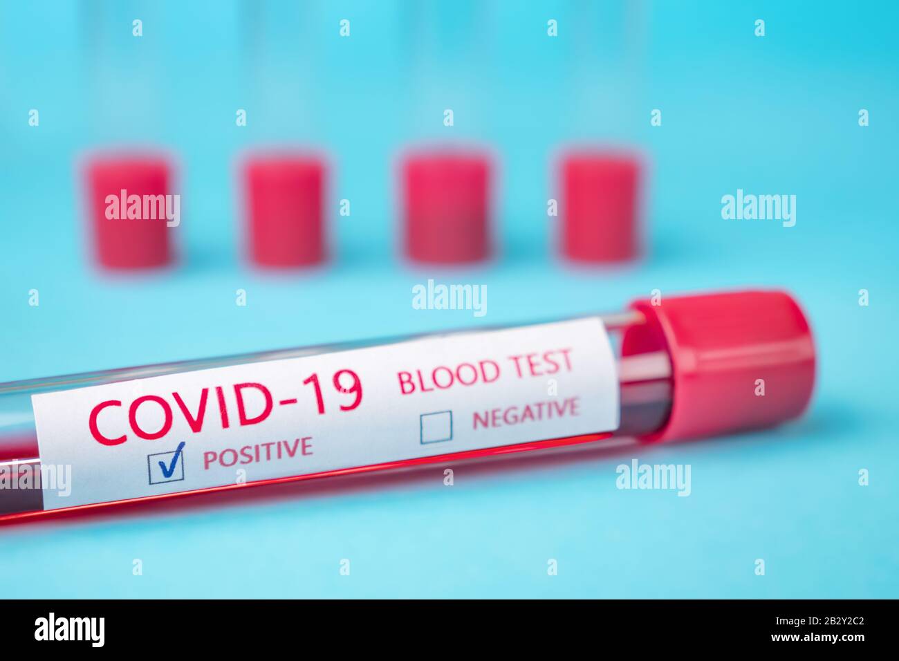 Coronavirus Kovid 19-infizierte Blutprobe im Probenröhrchen. Coronavirus Kovid-19-Impfstoffforschung. Krankenhaus konzeptionell. Hintergrund der Klinik. Epidemie, Pandemiehintergrund. Diagnose Stockfoto