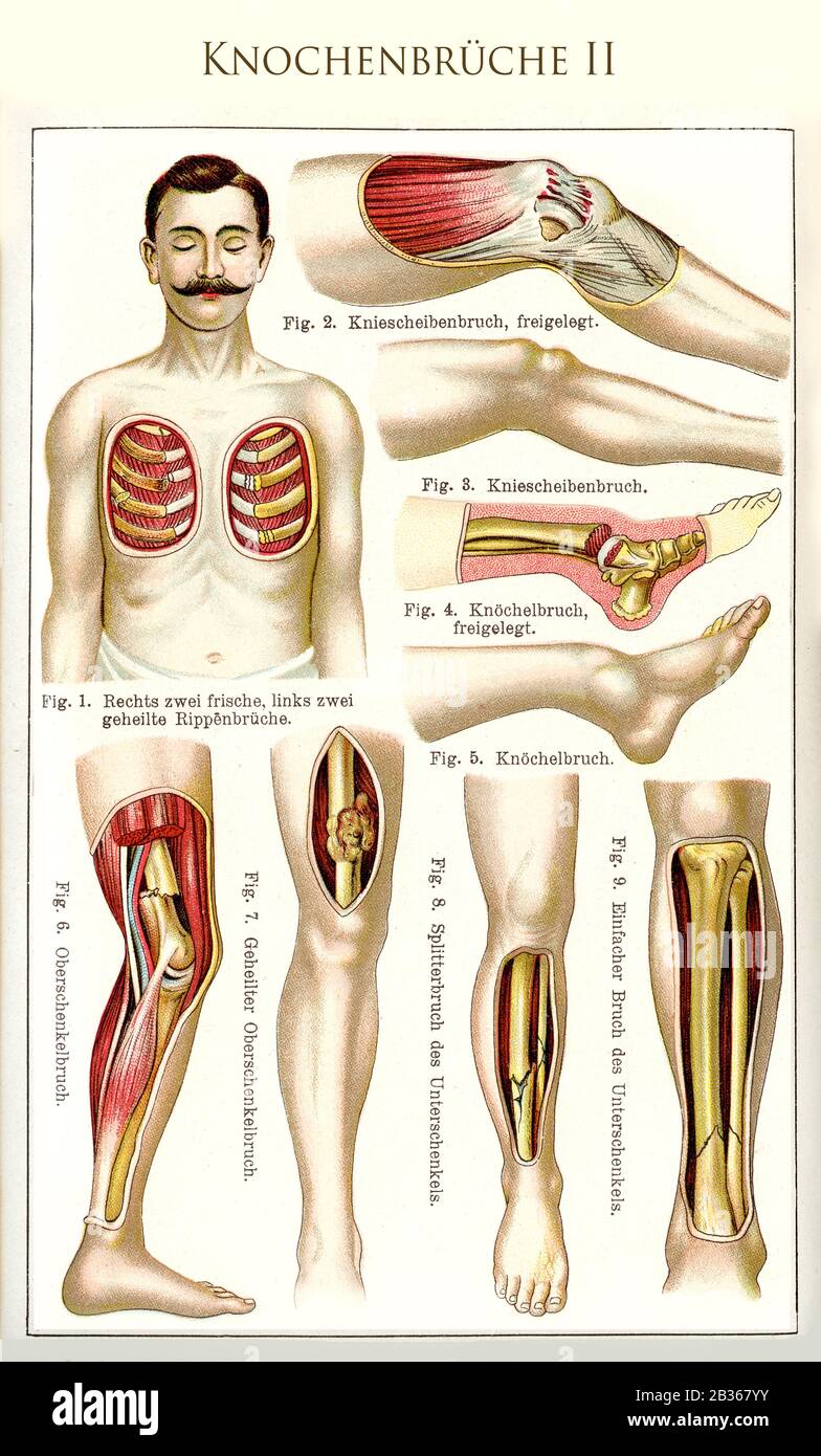Gesundheit und Medizin: Knochenbrüche färben Tabelle II mit mehreren Beispielen für Rippen-, Bein-, Knöchel- und Kniefrakturen mit deutschen Beschreibungen Stockfoto