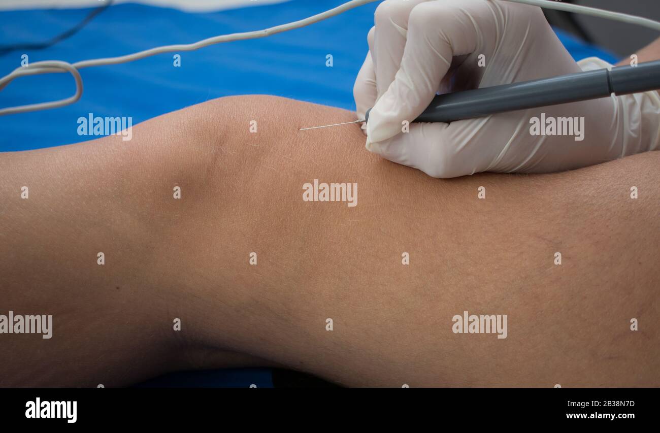 MEP, Percutaneous Micro Electrolysis Rehabilitation Stockfoto