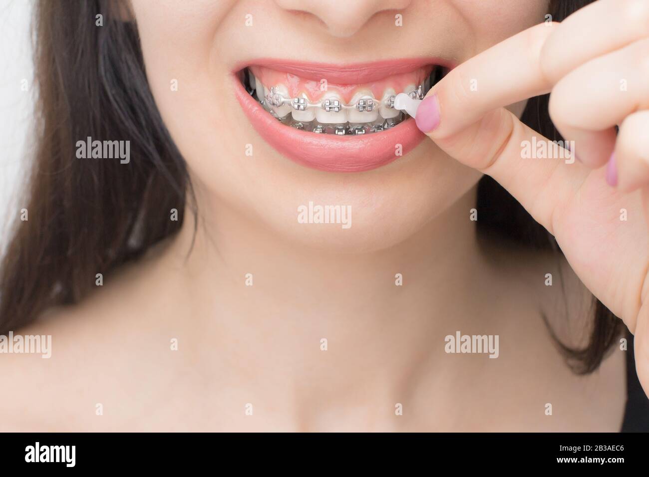 Orhodentisches Wachs auf die Zahnspange auftragen. Halterungen an den Zähnen nach dem Aufhellen. Selbstligierende Halterungen mit Metallbändern und grauen Gummizügen oder Stockfoto