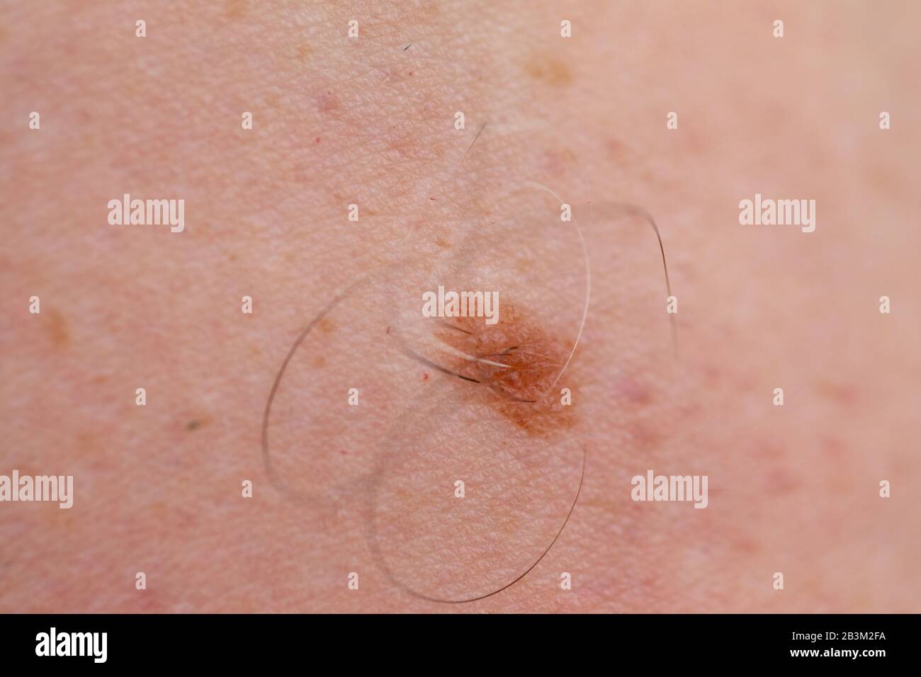 In der Nähe Bild von gefährlichen braunen Muttermale auf der menschlichen Haut - Melanom Stockfoto