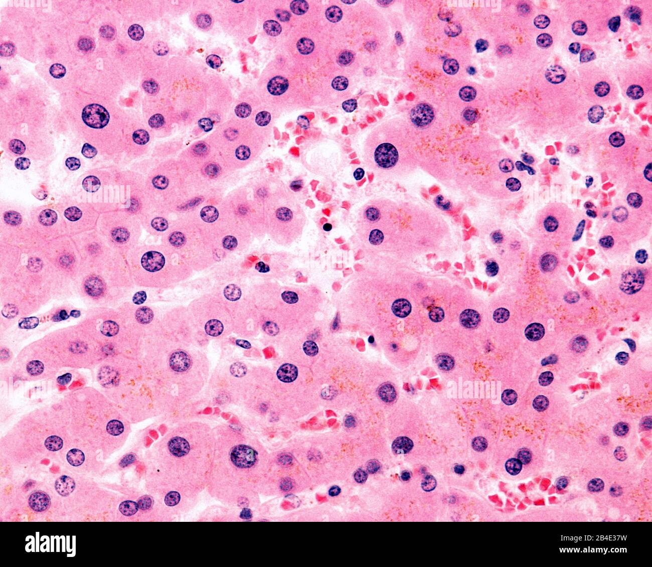 Polyploide Hepatozyten. Mehrere Hepatozyten zeigen einen sehr großen Zellkern. Diese Zellen sind polyploid, mit dem 4-, 8-, 16- oder mehr-fachen der haploiden Chromosomenbeere Stockfoto