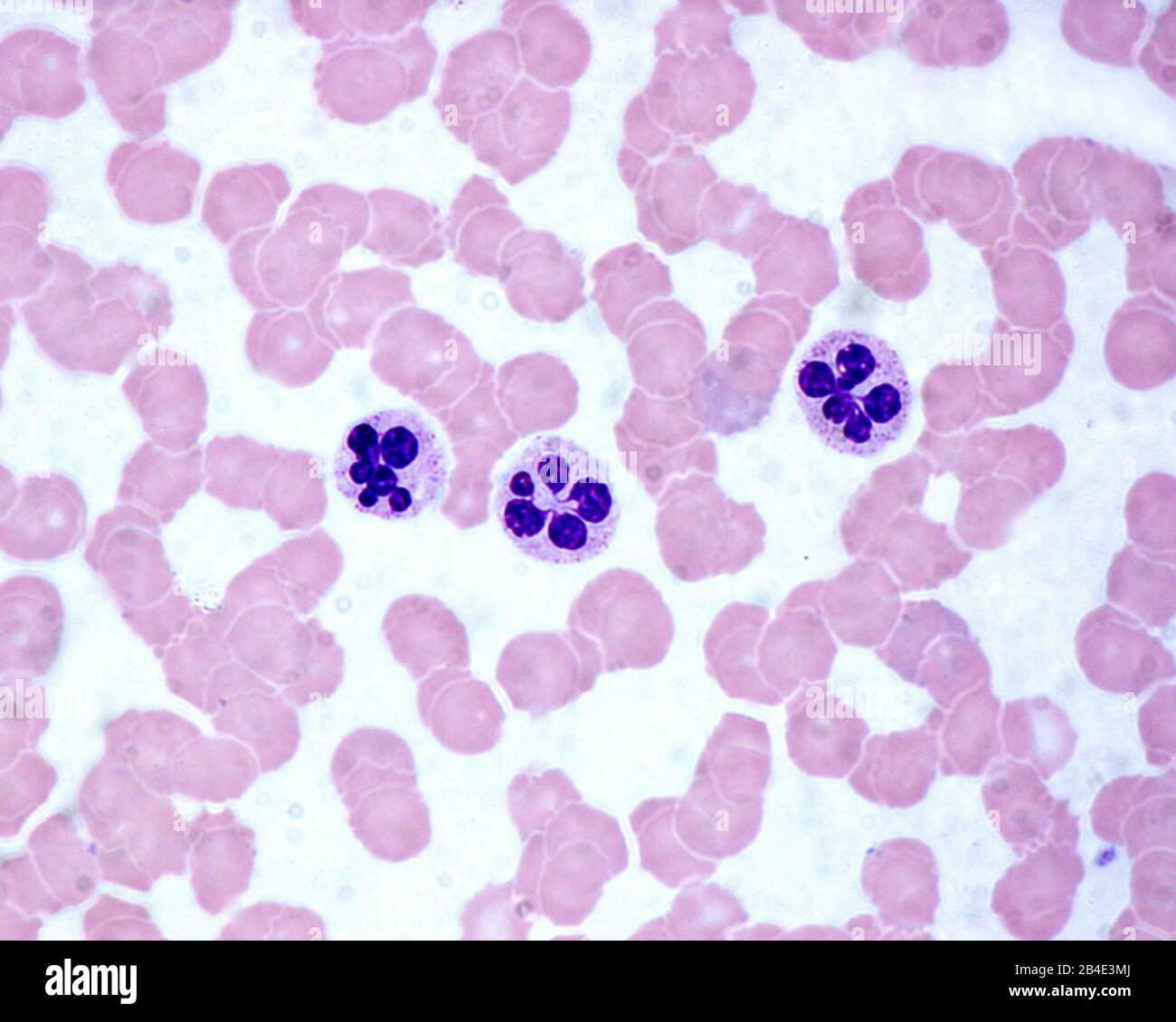 Blutabstrich zeigt in der Mitte drei Neutrophile mit hypersegmentiertem Zellkern. Diese Zellen treten in pathologischen Situationen wie Größenwahn auf Stockfoto