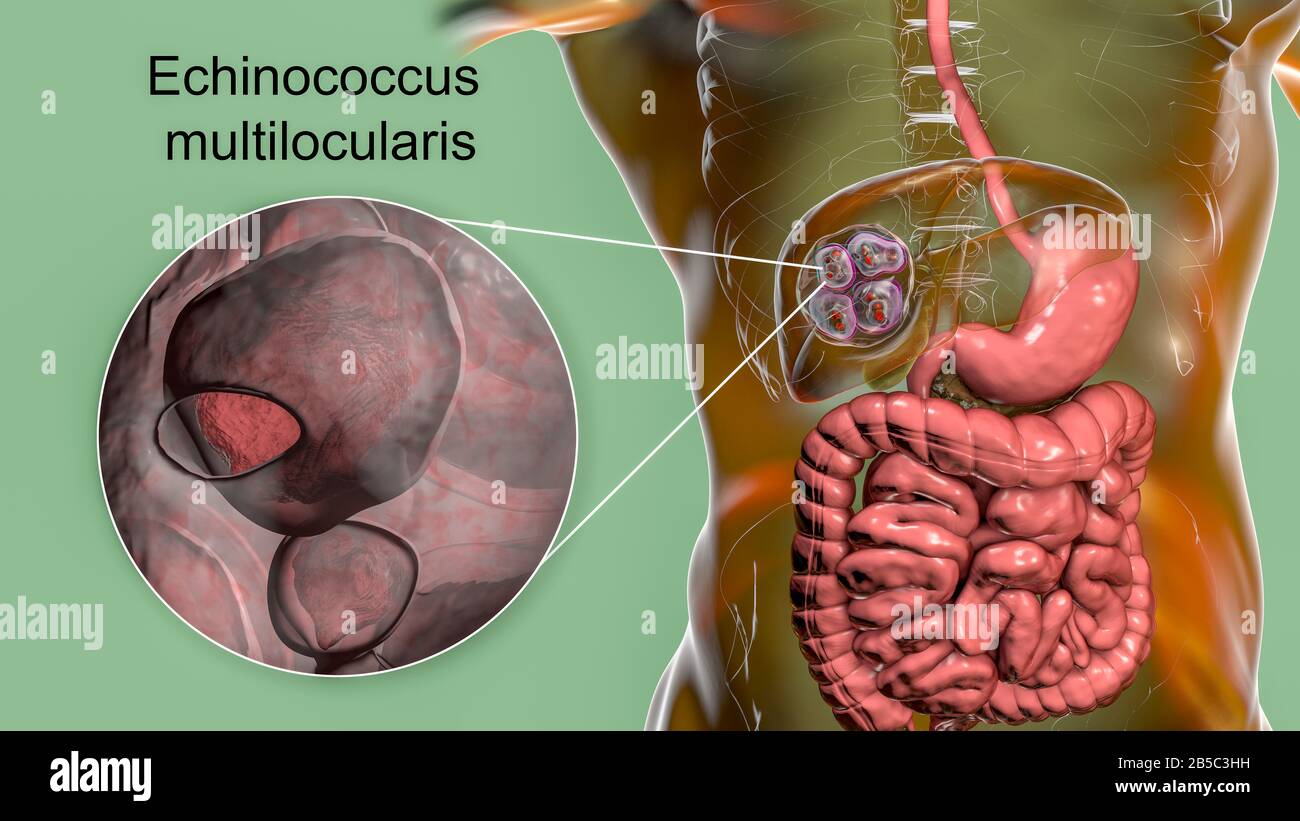 Hydatid-Krankheit in der Leber, alveoläre Echinokokkose, Illustration Stockfoto