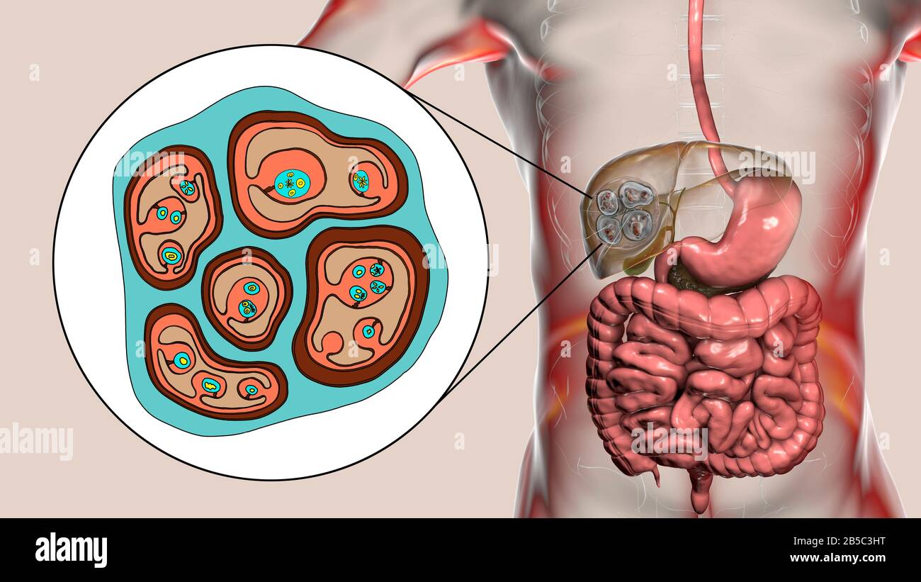 Hydatid-Krankheit in der Leber, alveoläre Echinokokkose, Illustration Stockfoto