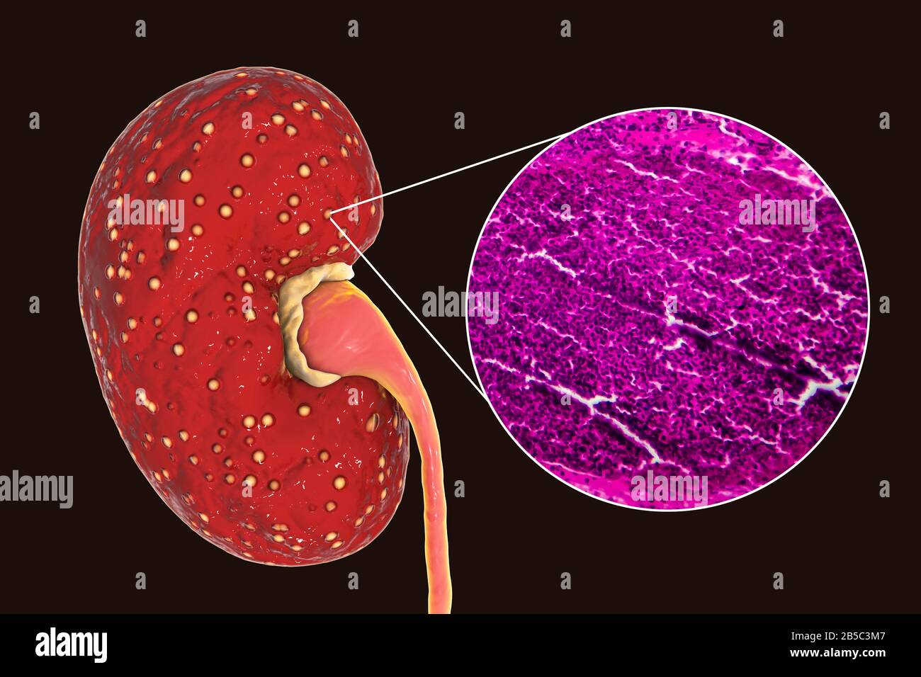 Absceso renal -Fotos und -Bildmaterial in hoher Auflösung – Alamy