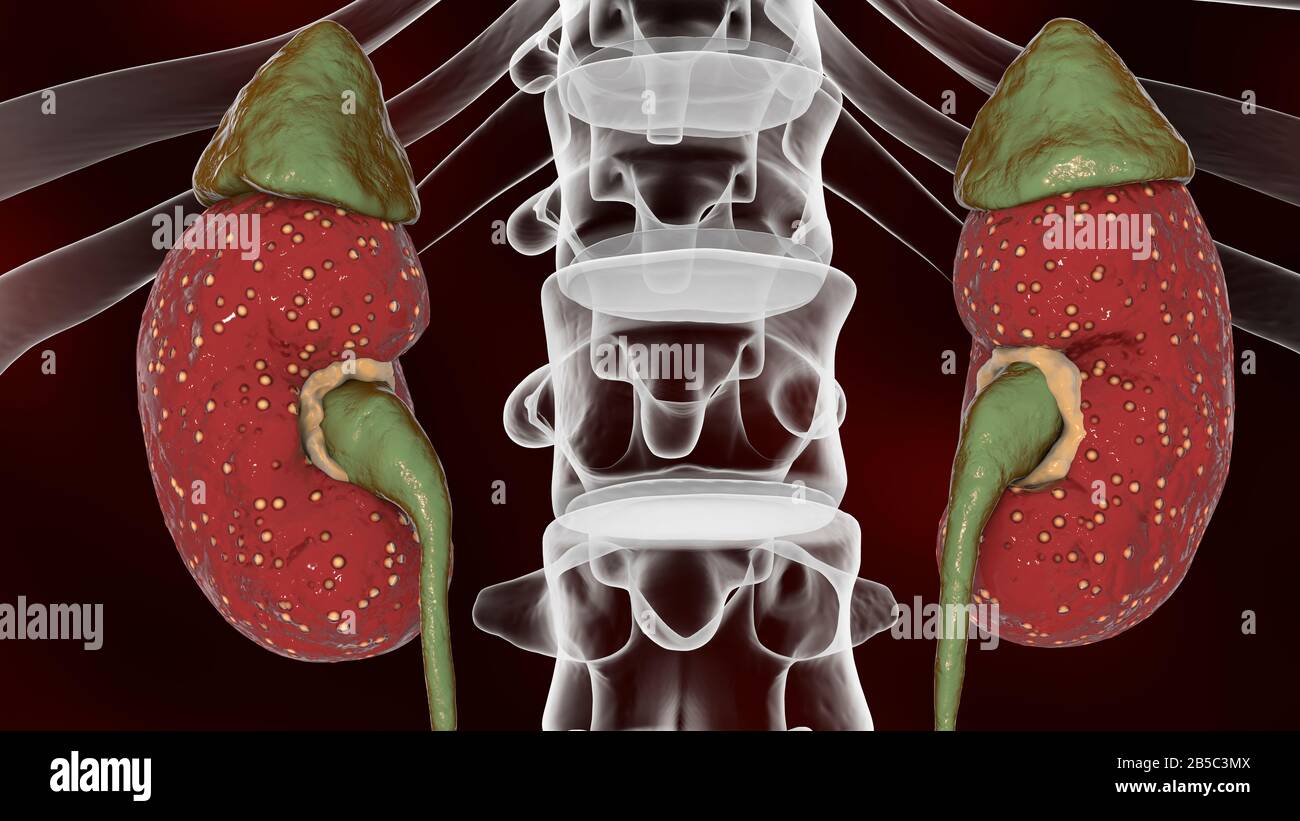 Akute Pyelonephritis, Abbildung Stockfoto