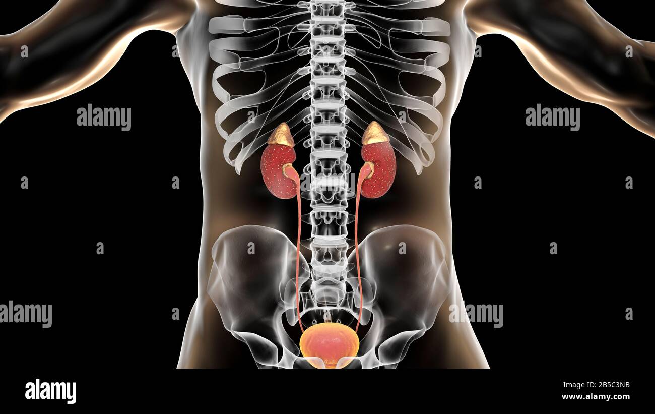 Akute Pyelonephritis, Abbildung Stockfoto