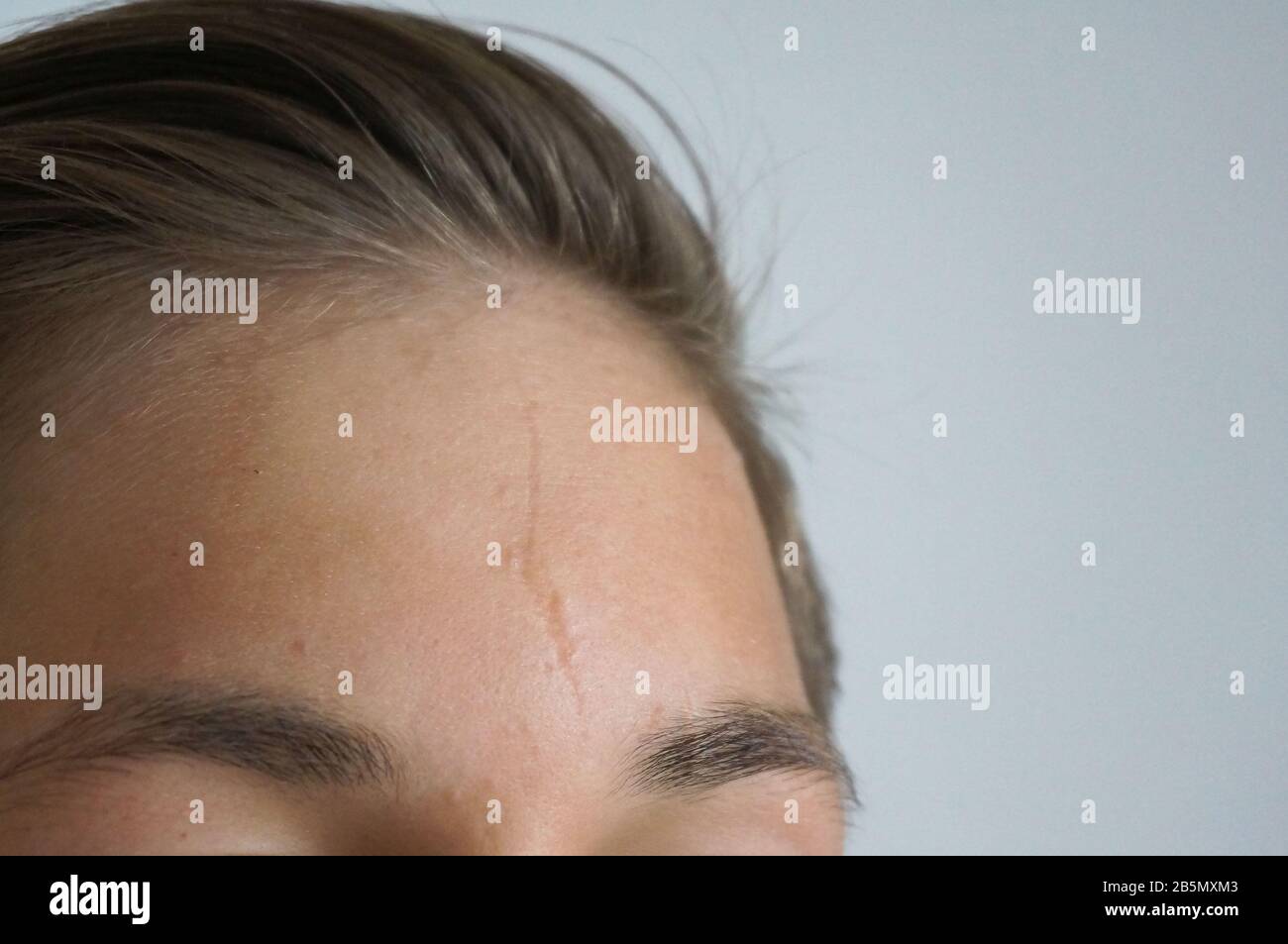 Teenager Stirn Nahaufnahme, junge Haut Unvollkommenheit Narbe und Akne Stockfoto