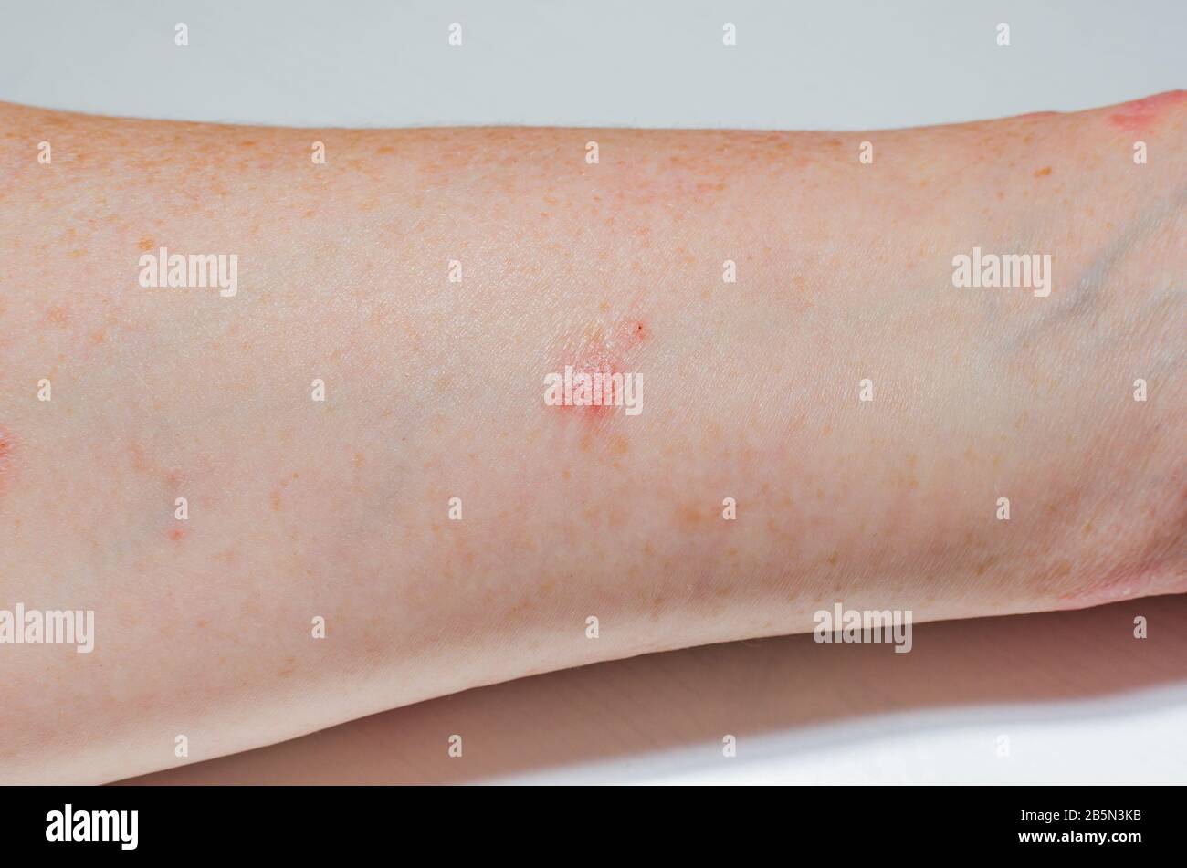 Was Tun Bei Allergischer Reaktion Der Haut www.alamy.de