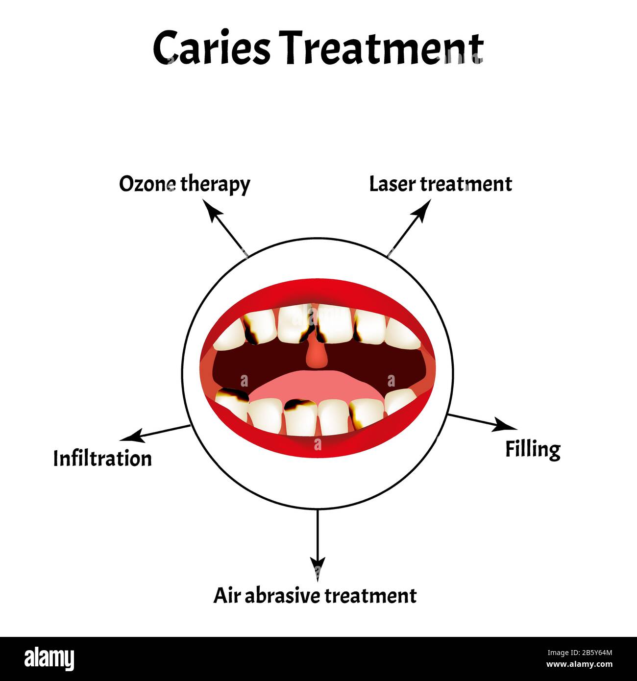 Parasitäre Erkrankungen der Phthiriasis. Pediculosis pubis. Schamlice