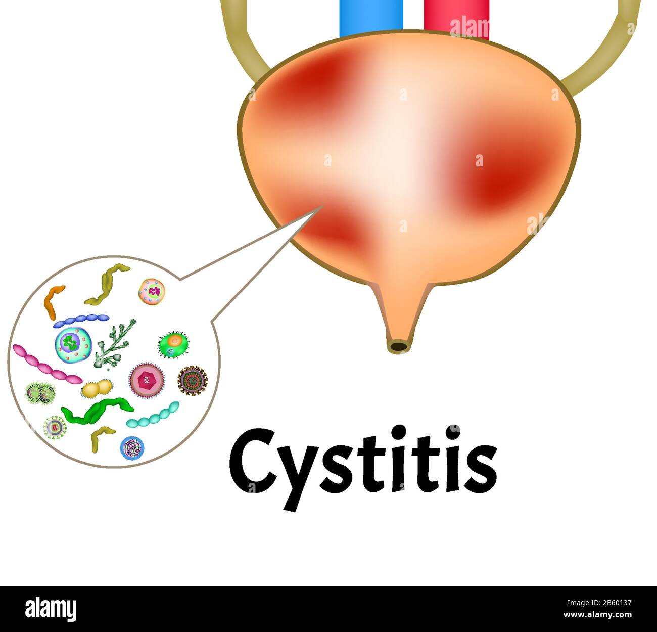 Zystitis. Entzündung der Blase. Die Struktur der Nieren und der Blase. Exkretorium. Infografiken. Vektorgrafiken auf isoliert Stock Vektor