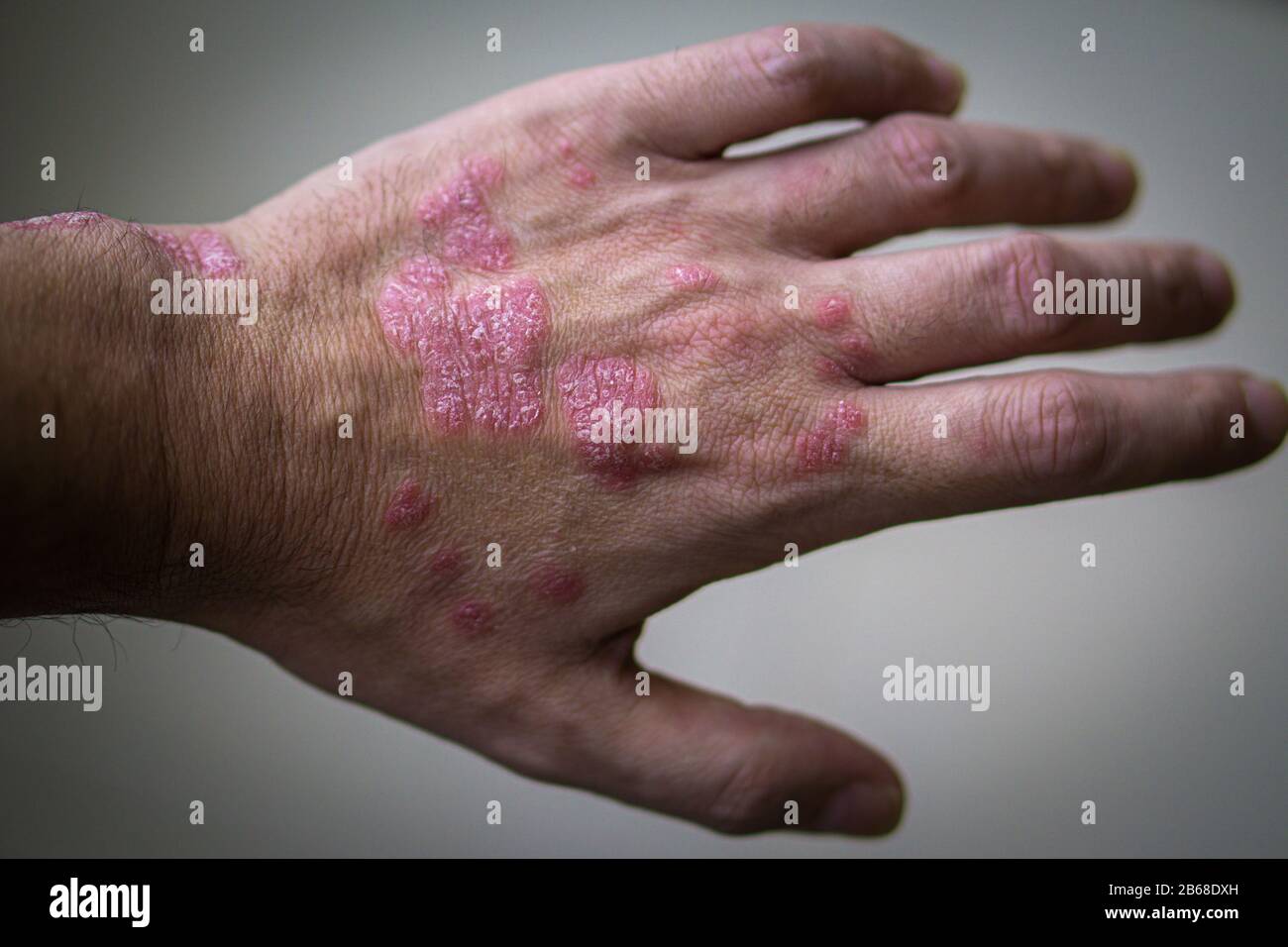 Psoriasis. Autoimmune Hauterkrankung. Hand des Menschen mit Taschen von Psoriasis-Läsion auf grauem Hintergrund. Stockfoto