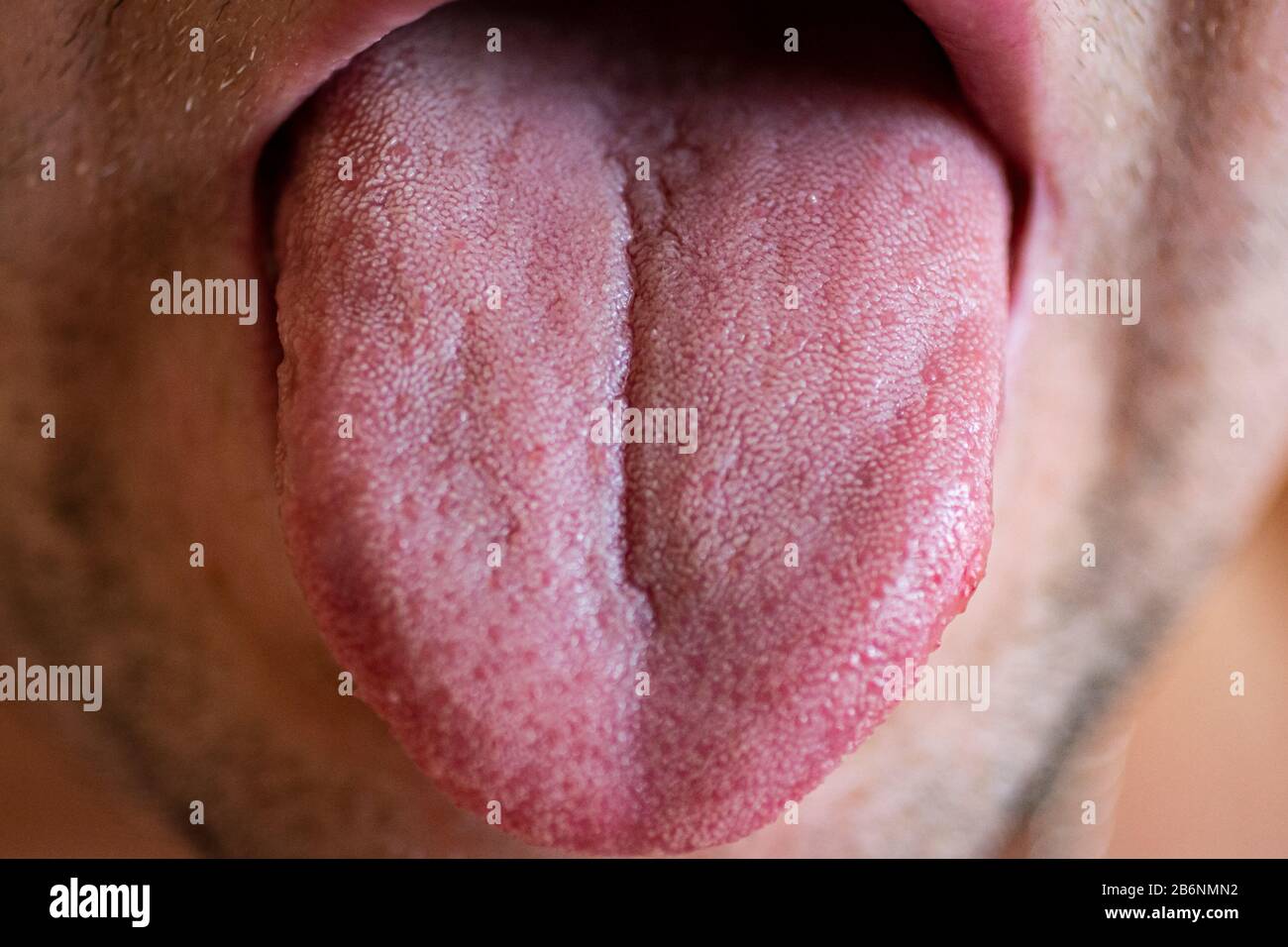 Zunge eines Mannes mit weißer Beschichtung. Stockfoto