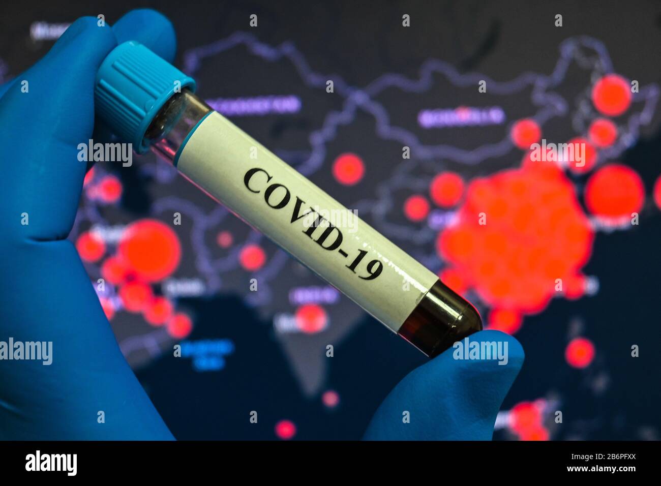 Blutuntersuchungen für das Coronavirus, das COVID-19 verursacht. Eine Blutprobe für die Prüfung auf SARS-COV-2. Stockfoto
