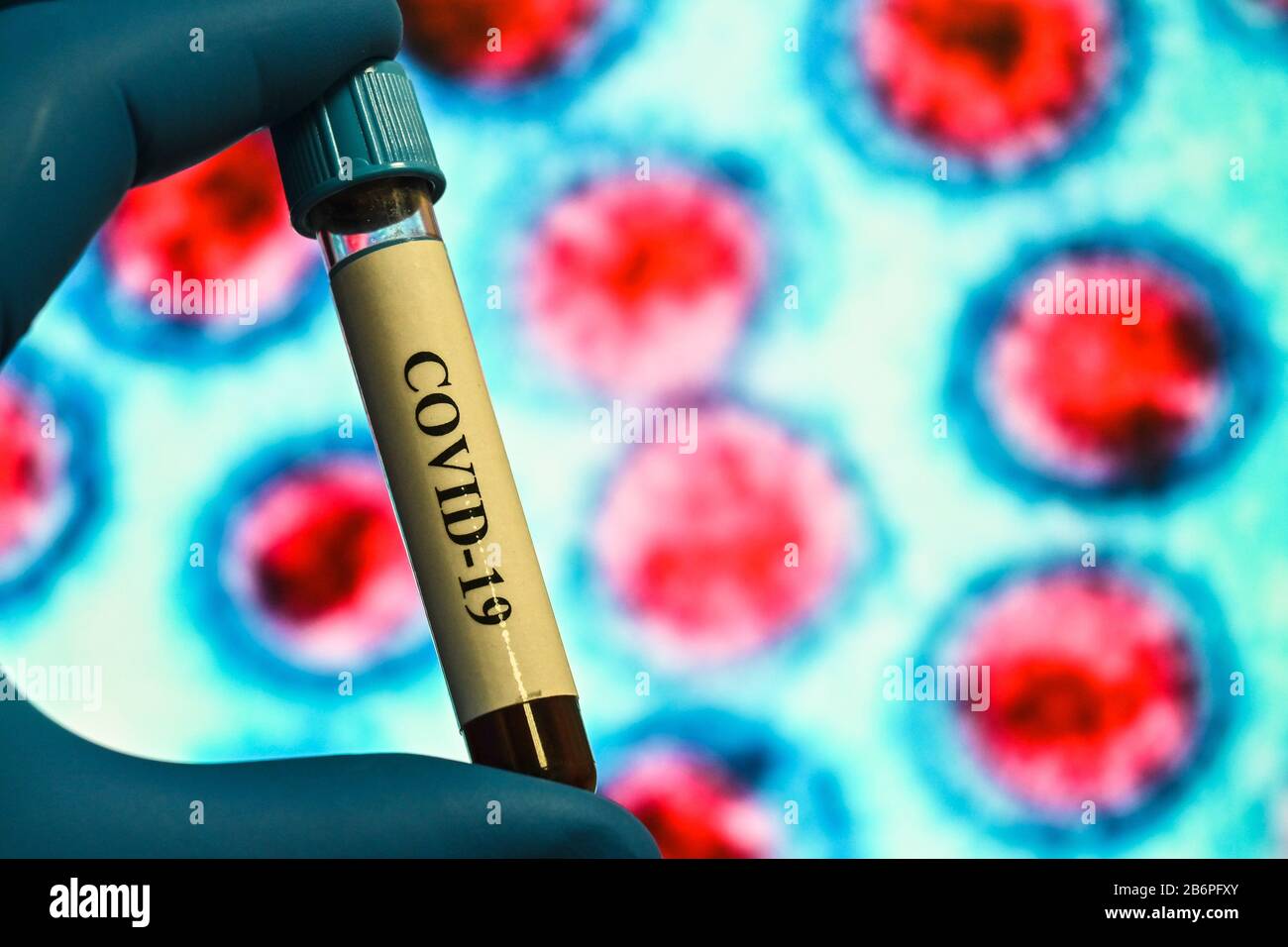 Blutuntersuchungen für das Coronavirus, das COVID-19 verursacht. Eine Blutprobe für die Prüfung auf SARS-COV-2. Stockfoto