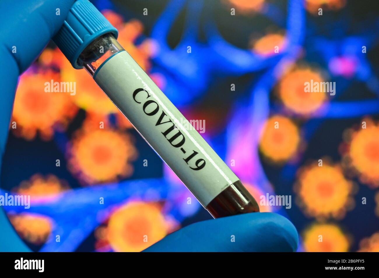 Blutuntersuchungen für das Coronavirus, das COVID-19 verursacht. Eine Blutprobe für die Prüfung auf SARS-COV-2. Stockfoto