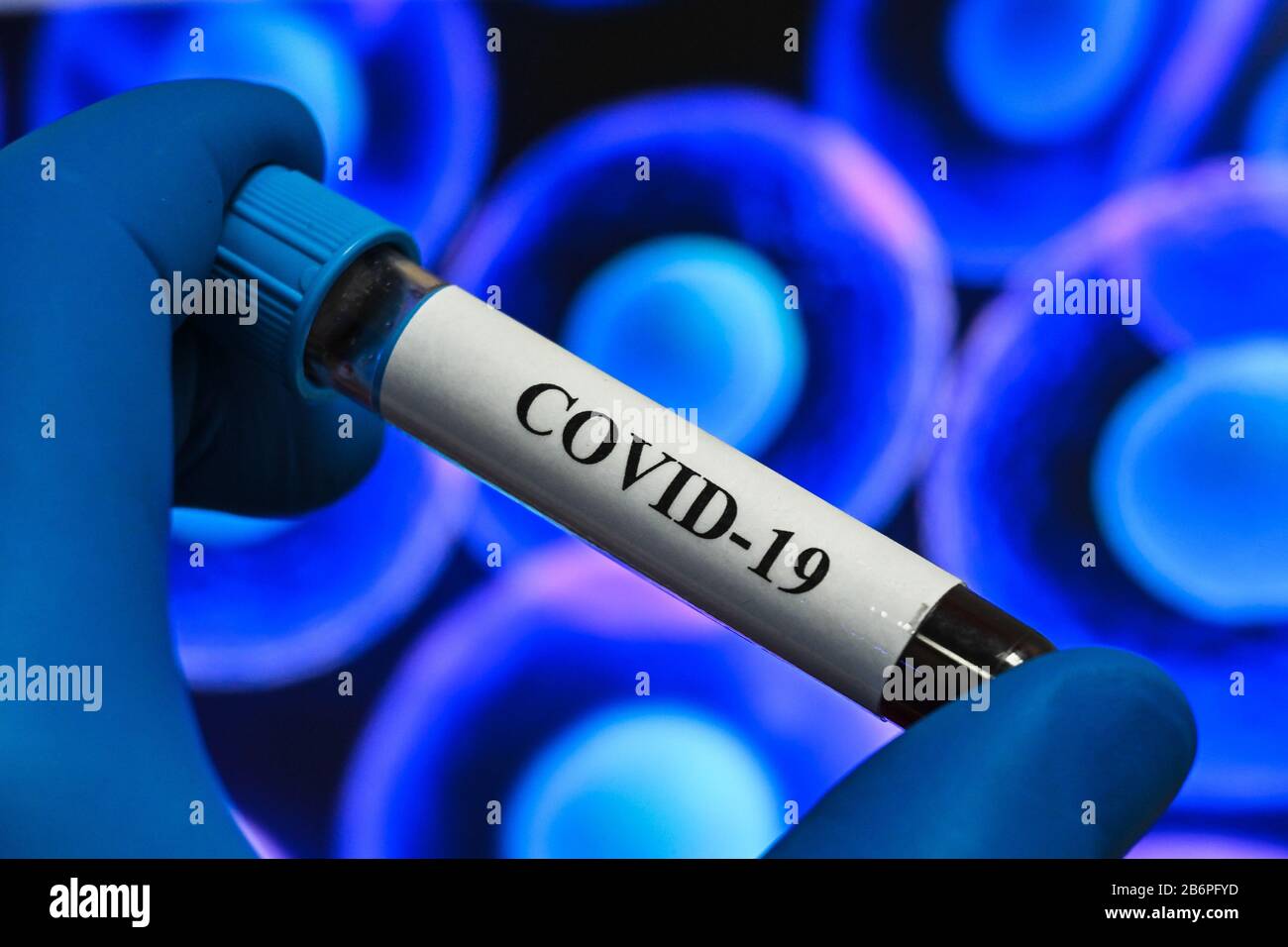 Blutuntersuchungen für das Coronavirus, das COVID-19 verursacht. Eine Blutprobe für die Prüfung auf SARS-COV-2. Stockfoto