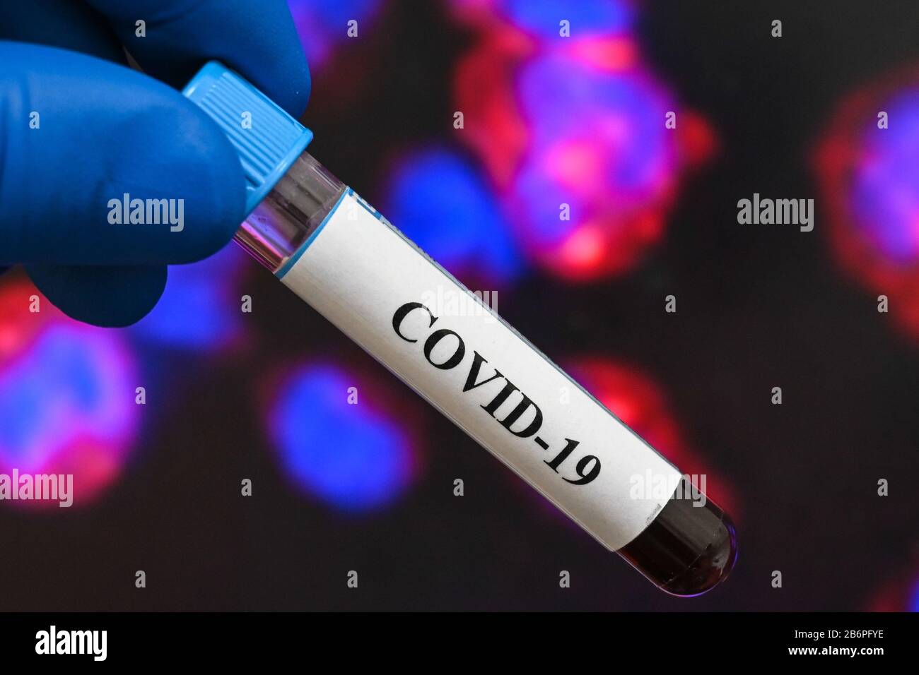 Blutuntersuchungen für das Coronavirus, das COVID-19 verursacht. Eine Blutprobe für die Prüfung auf SARS-COV-2. Stockfoto