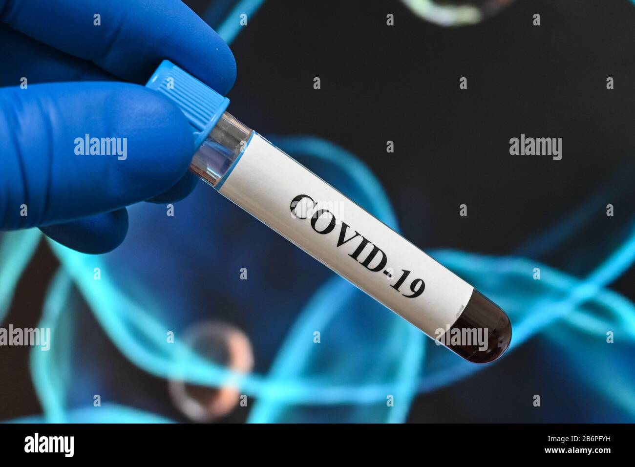 Blutuntersuchungen für das Coronavirus, das COVID-19 verursacht. Eine Blutprobe für die Prüfung auf SARS-COV-2. Stockfoto