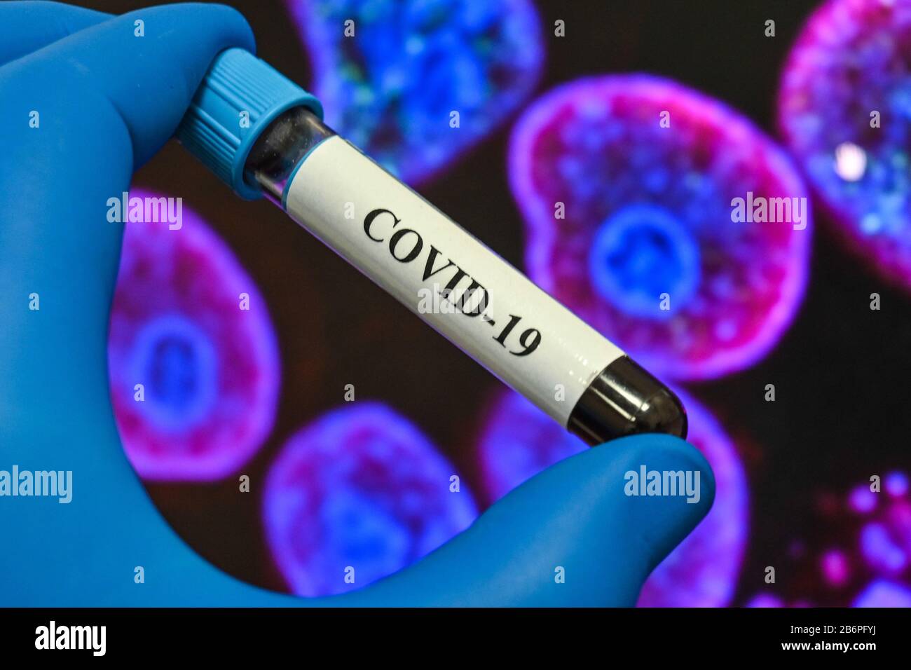 Blutuntersuchungen für das Coronavirus, das COVID-19 verursacht. Eine Blutprobe für die Prüfung auf SARS-COV-2. Stockfoto
