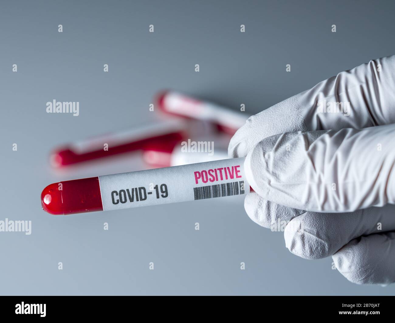Medizinischer Handschuh, der ein Blutrohr mit einem positiven Ergebnis für den Test auf Covid-19 oder Coronavirus hält Stockfoto