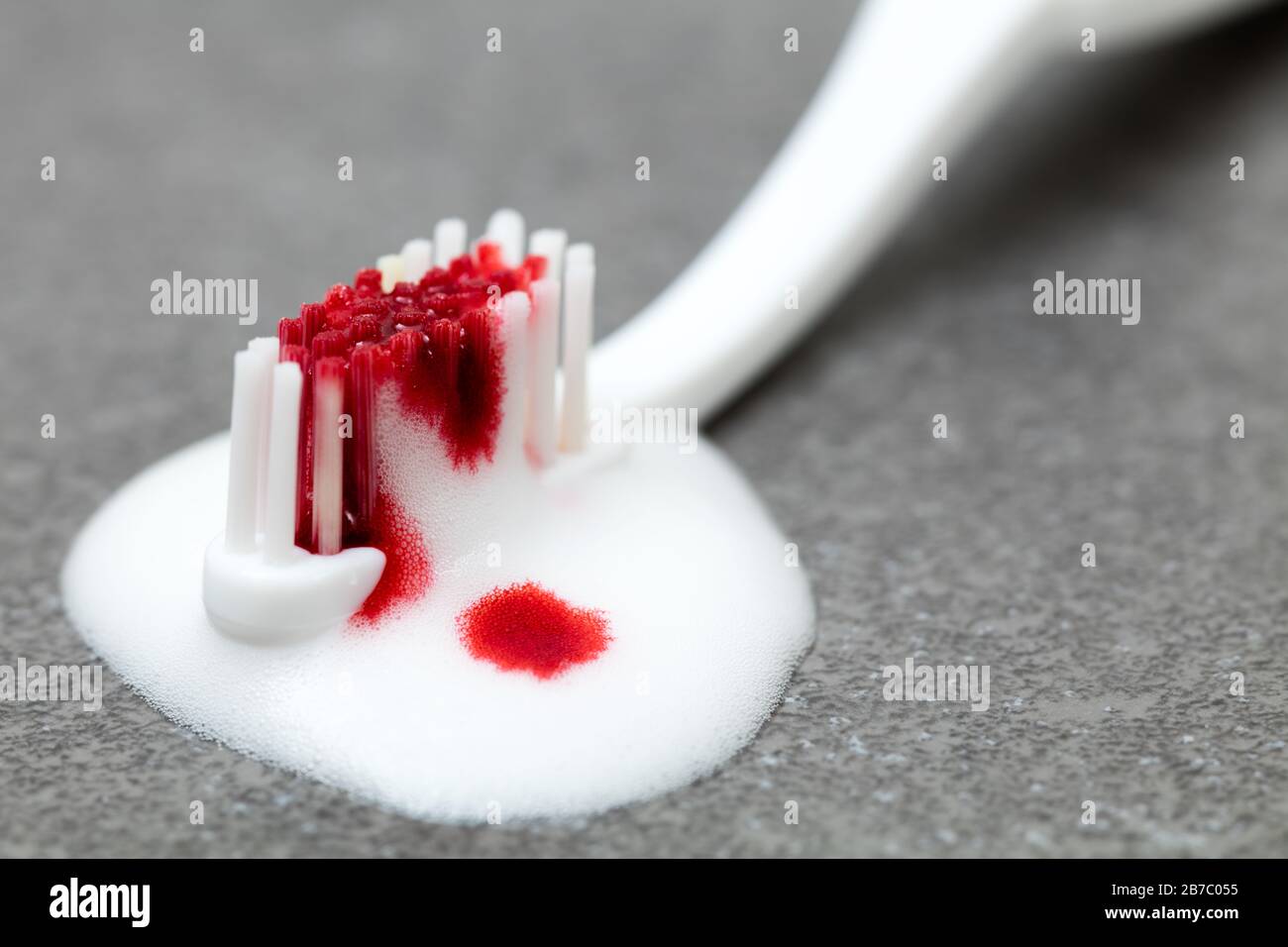 Eine weiße blutige Zahnbürste - Gum Krankheit und Karies Stockfoto