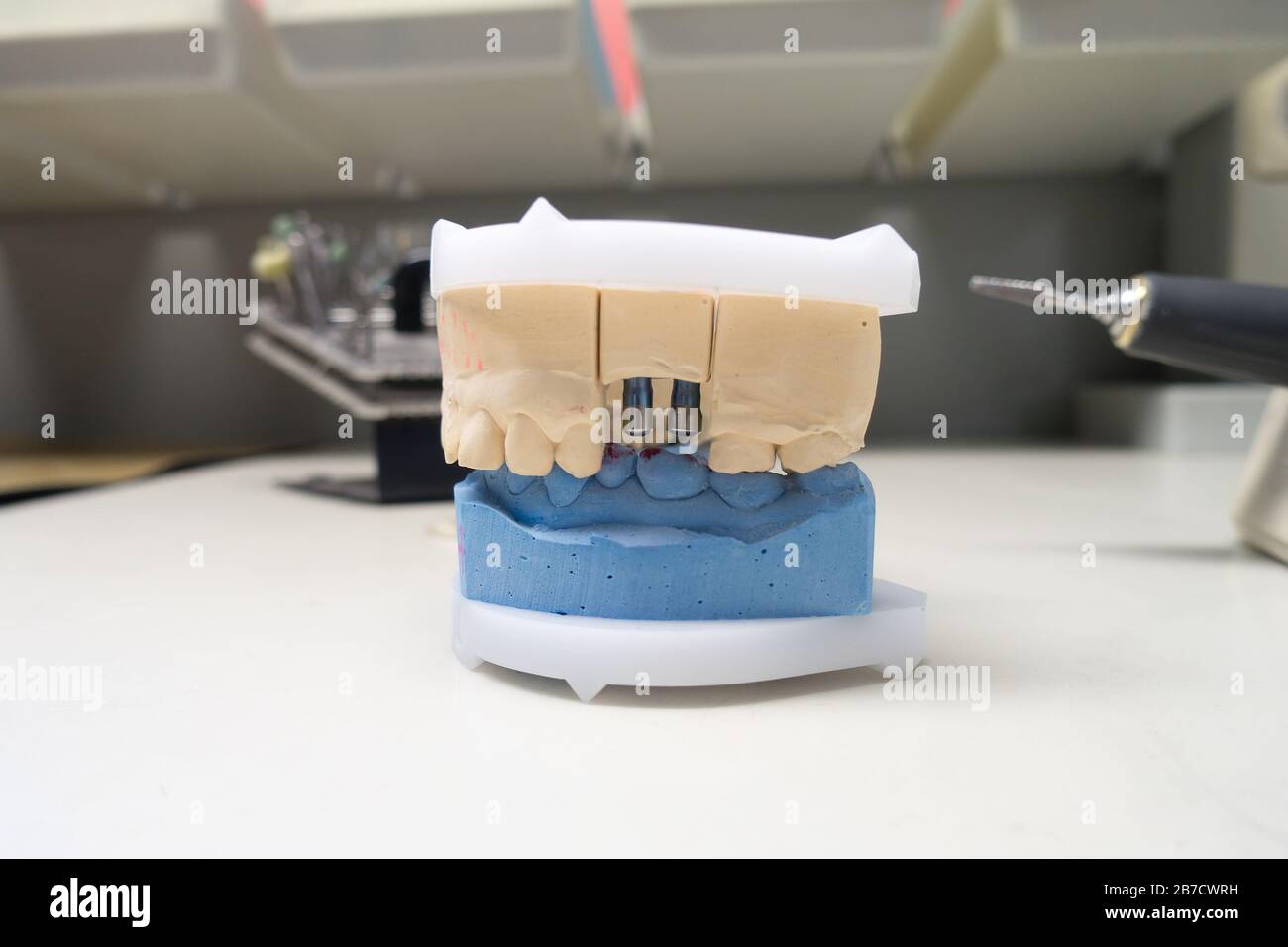 Gipsmodell des menschlichen Kiefers mit Zahnimplantaten Stockfoto