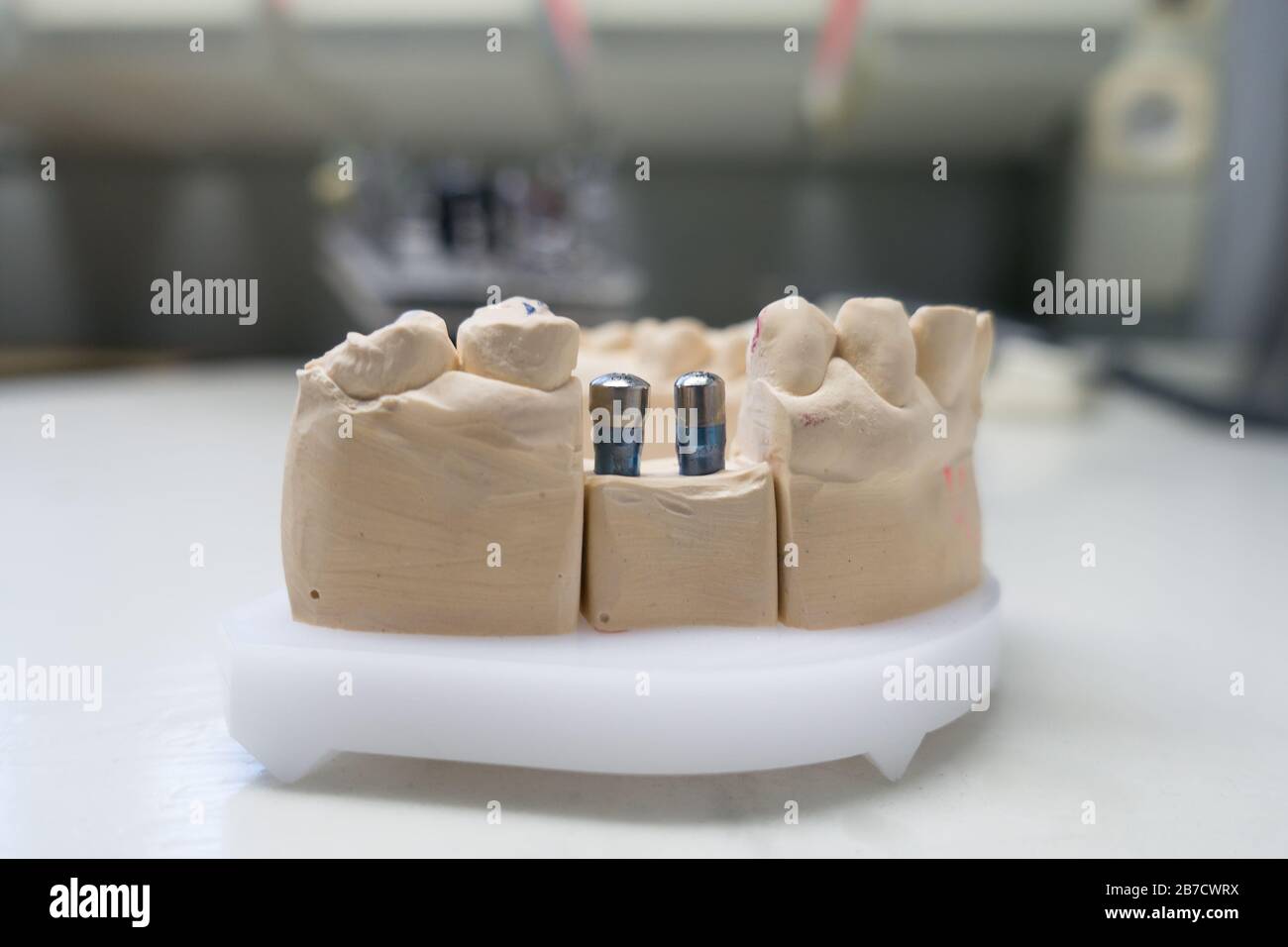 Gipsmodell des menschlichen Kiefers mit Zahnimplantaten Stockfoto