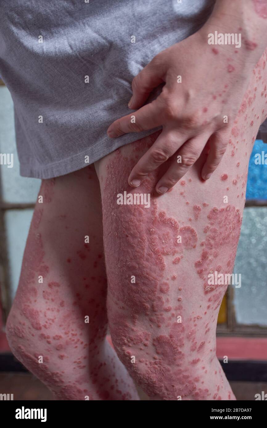 Ansicht des Oberschenkels der Frau mit Psoriasis Stockfoto